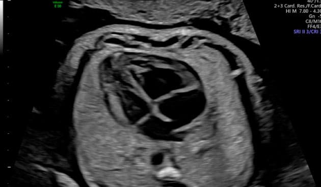 ecocardiografia fetal vientre materno