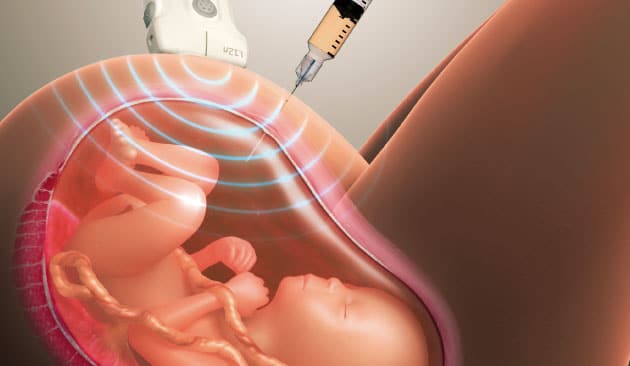 amniocentesis ecografias en lima peru instituto peruano de medicina y cirugia fetal