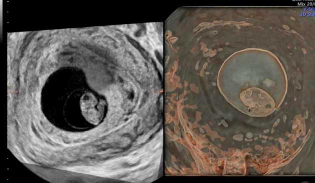 biopsia de vellosidades coriales en lima peru instituto peruano de medicina y cirugia fetal