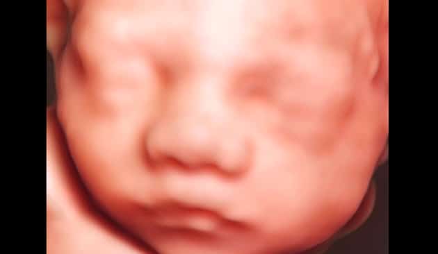 ecografia morfologica gemelar instituto peruano de medicina y cirugia fetal 2